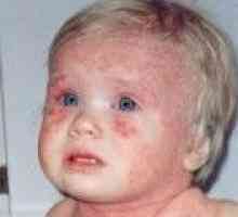 Атопичен дерматит при деца, симптоми и лечение
