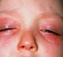 Алергия към очите, което се проявява? Как да се лекува?