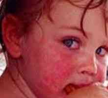 Алергия към сладко при деца, при възрастни, лечение