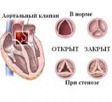 Аортна стеноза