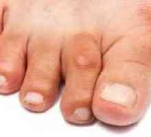 Артрит на пръстите на краката и ходилата, симптоми и лечение