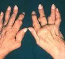 Артрит на ставите на пръстите на ръцете: симптоми и лечение