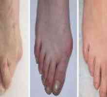 Остеоартритът на крака: Причини, симптоми, лечение