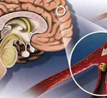Церебрални симптоми и лечение атеросклероза