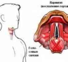 Болки в гърлото при преглъщане поради ларингит
