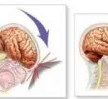 Травматично увреждане на мозъка - последствията, рехабилитация