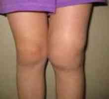 Деформирайки артроза на колянната става