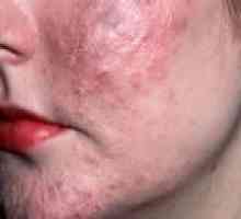 Акне кожата: причини, симптоми, лечение