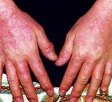 Диагностика и лечение на алергичен дерматит