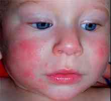 Диатеза при новороденото по лицето: лечение