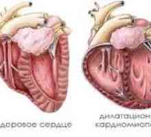 Забавена кардиомиопатия, причини, симптоми, лечение