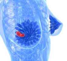 Фиброциститно заболяване на гърдата: симптоми