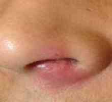 Сварете в носа: симптоми, причини, лечение