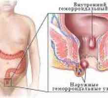 Хемороиди след раждане: причините, симптомите, лечението