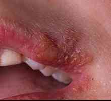 Херпес на устните: причини, превенция, лечение