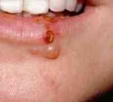 Херпес по устните - причини, симптоми, лечение