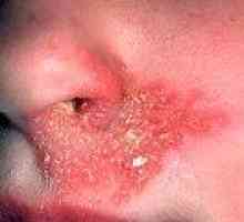 Студената раните в носа, под носа: Причини, Лечение