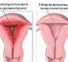 Лечение ендометриална хиперплазия менопауза
