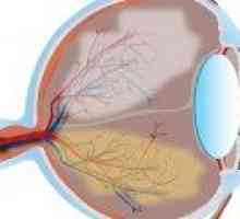 Глаукома - профилактика и лечение на глаукома