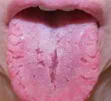Възпаление на езика
