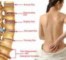Сакралната гръбнака херния: симптоми, лечение