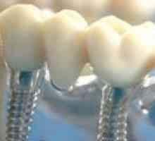 Зъбните импланти: ключови факти