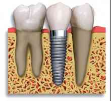 Зъбните импланти: противопоказания и възможни усложнения