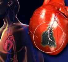 Сърдечен удар при мъжете, така и жените: симптомите и признаците на