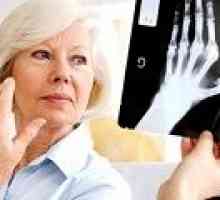 Уврежданията при ревматоиден артрит: Причини