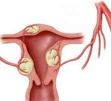 Емболизация на миома на матката