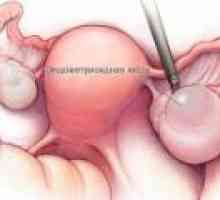 Endometrioid киста на яйчниците - причини, симптоми, лечение
