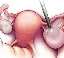 Endometrioid киста на яйчниците