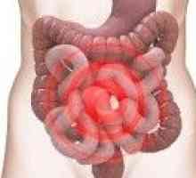 Как се лекува Синдром на раздразненото дебело черво?