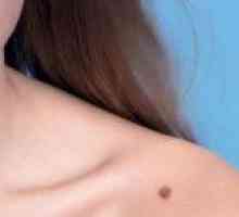 Как да се идентифицират и да се излекува меланом на кожата