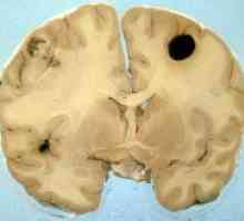 Как да разпознаем и лечение на меланом мозъка