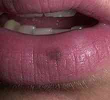 Как да се диагностицира и лекува меланом на устната