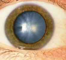Катаракта - един от най-честите очни заболявания