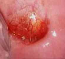 Рак на шийката на киста: причини и лечение