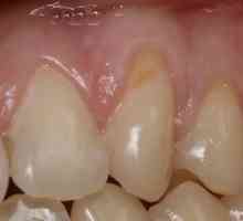 Зъби дефект на клиновидна