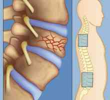 Компресия фрактура на гръбначния стълб: разнообразието и лечение