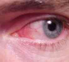 Конюнктивит или червени очи: симптоми, лечение