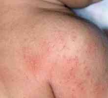 Алергия на кожата: причини, симптоми, лечение