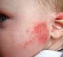 Червени петна по кожата на едно дете - причини, лечение