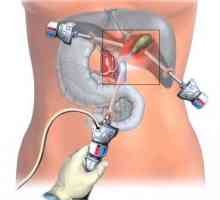 Лапароскопията жлъчния мехур: операцията минава