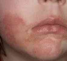 Лечение на себореен дерматит на лицето