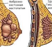 Кистозна болест на гърдата - причини, симптомите и лечението