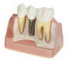 Зъбни импланти Методи