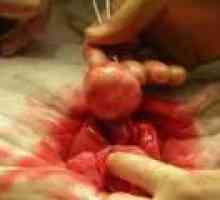 Миома на матката малък размер - причини, лечение