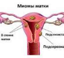 Множество миома на матката - причини, симптоми, лечение