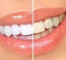 Възможно ли е да избелите зъбите си у дома? Най-популярните методи
